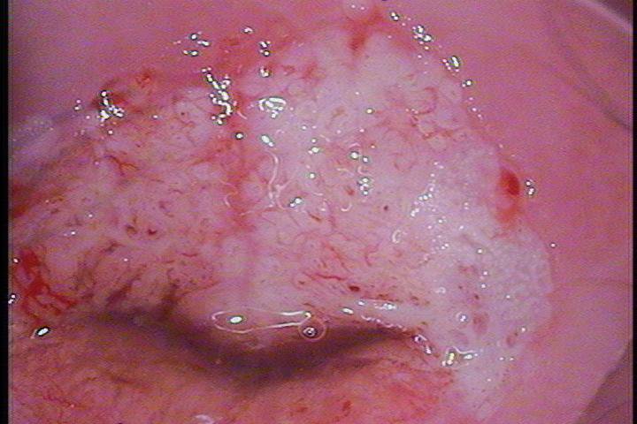 Cáncer in situ.