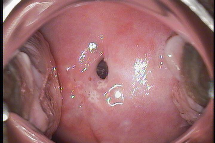 Cervix normal.