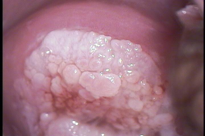 Condilomas cervicales.