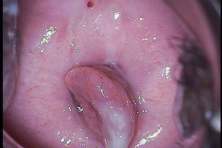Polipo endocervical.