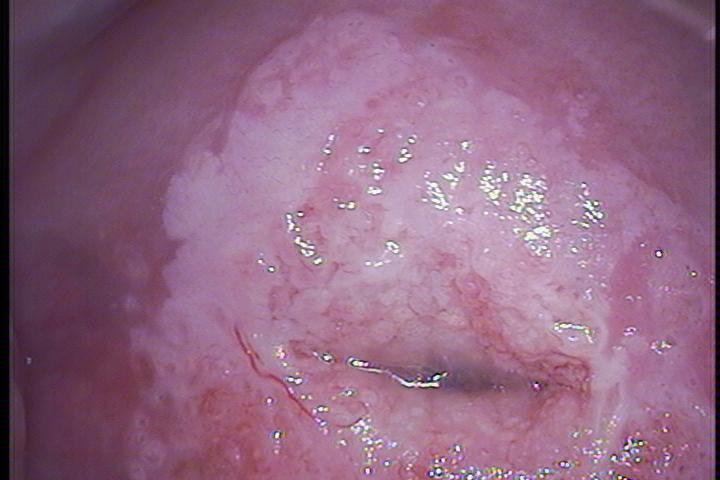 Virus del Papilóma.