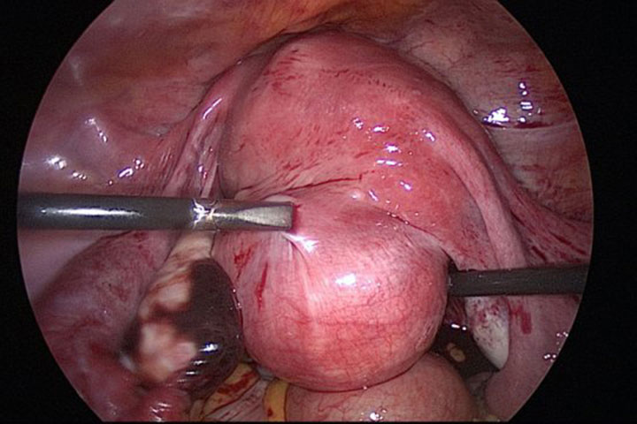 Cervix normal.