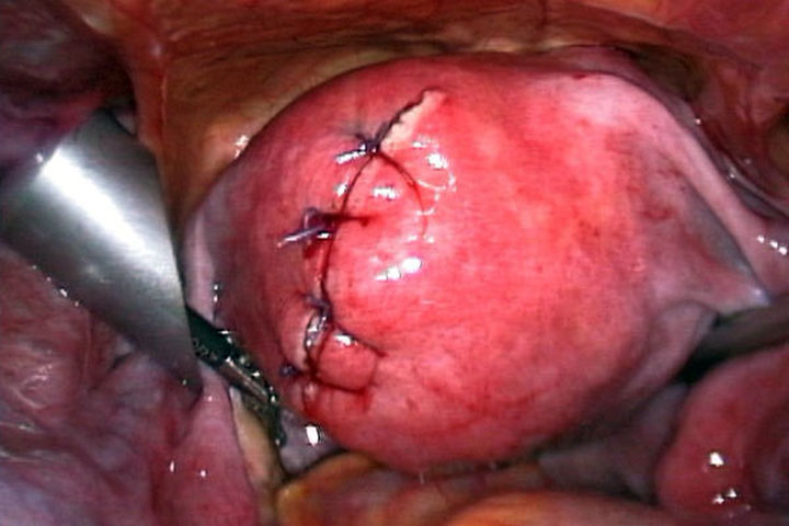 Condilomas cervicales.